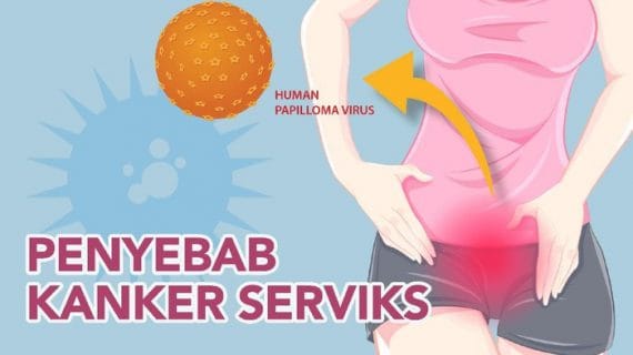 Penyebab Kanker Serviks